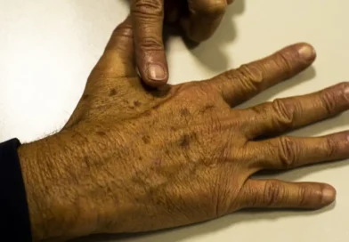 Casos de câncer em jovens adultos crescem 284% no Brasil